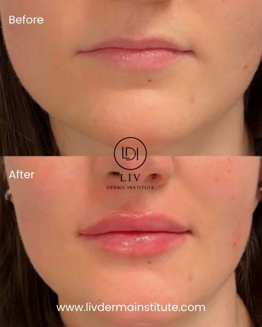 Voor en na: lippen – lipfillers bij LIV Derma Institute