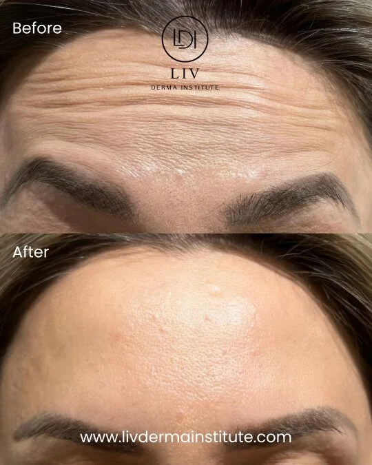 Voor en na: voorhoofdrimpels – spierontspanners bij LIV Derma Institute