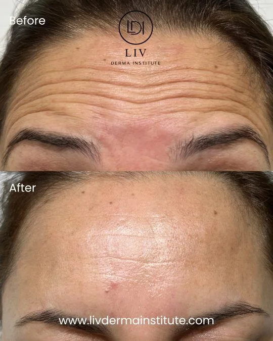 Voor en na: voorhoofdrimpels – spierontspanners bij LIV Derma Institute