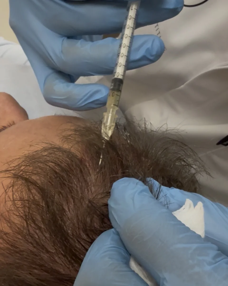 PRP haarbehandeling bij LIV Derma Institute