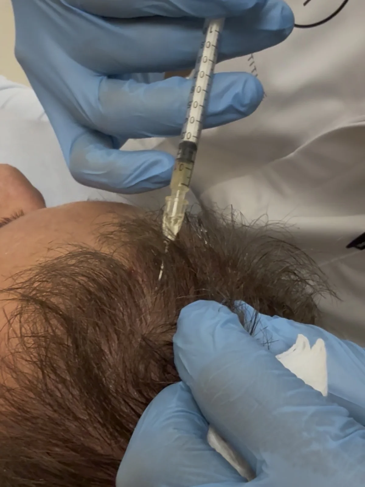 PRP haarbehandeling bij LIV Derma Institute