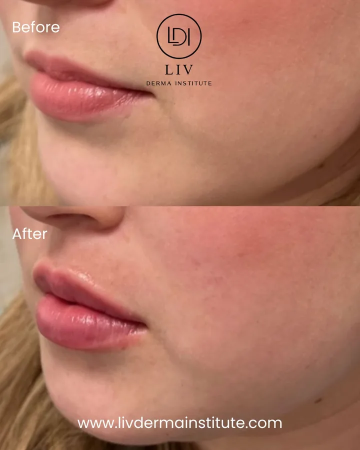 Voor en na: lippen – lipfiller bij LIV Derma Institute
