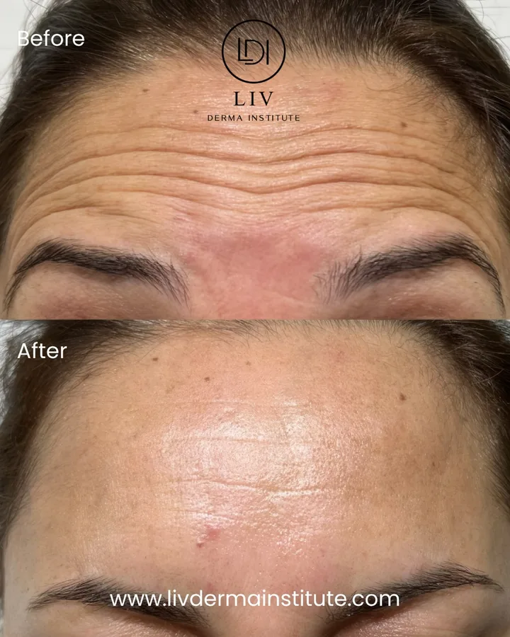 Voor en na: voorhoofdrimpels – spierontspanners bij LIV Derma Institute