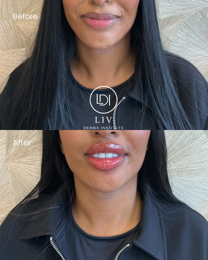 Voor en na: lippen – russian lips bij LIV Derma Institute