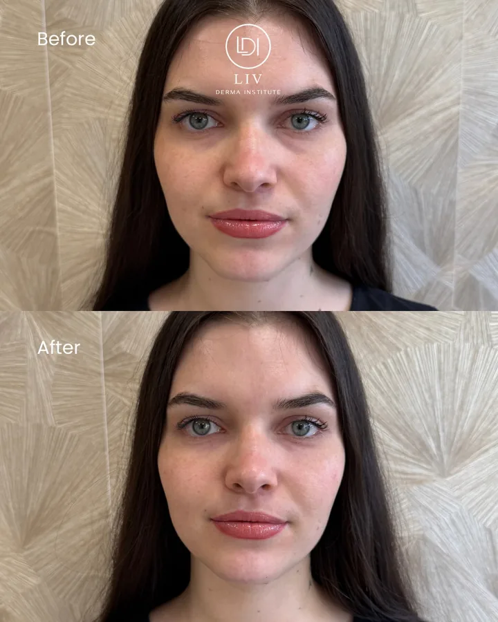 Voor en na: fronsrimpels – spierontspanners bij LIV Derma Institute