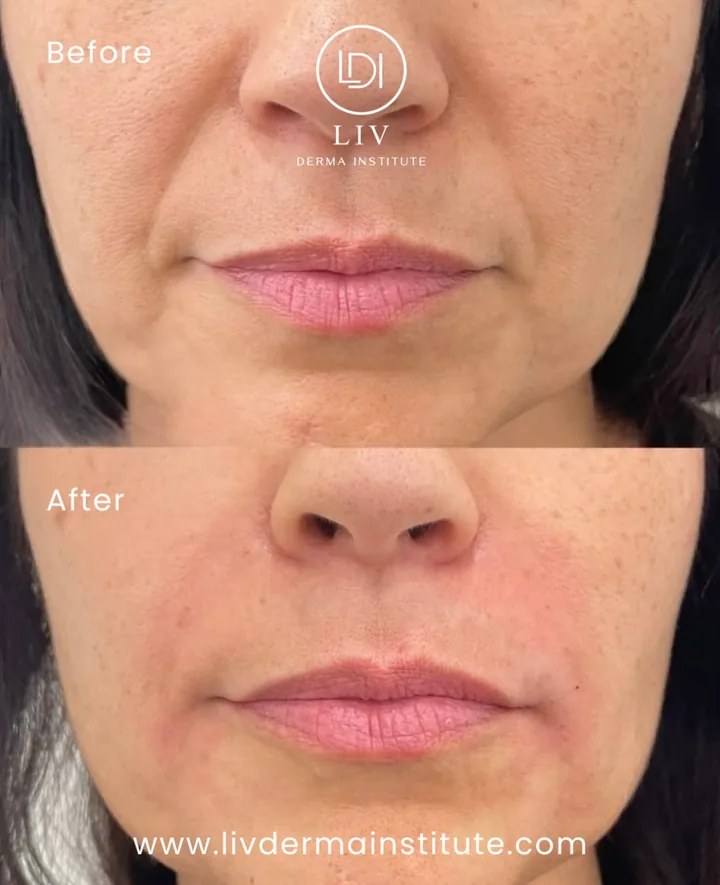 Voor en na: neus-lippenplooi – filler bij LIV Derma Institute