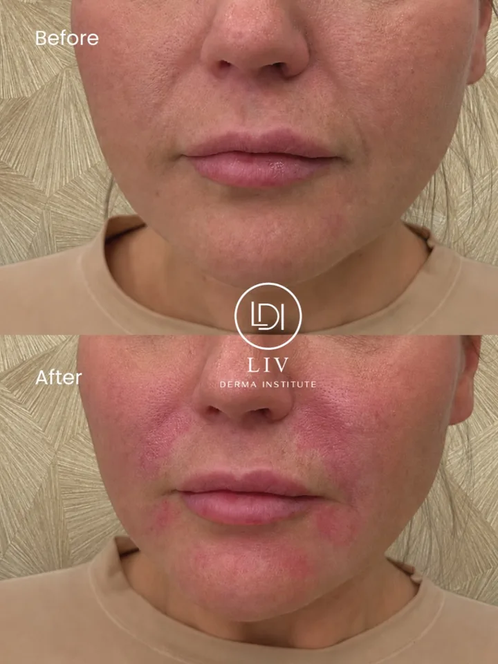 Voor en na: neus-lippenplooi – filler bij LIV Derma Institute