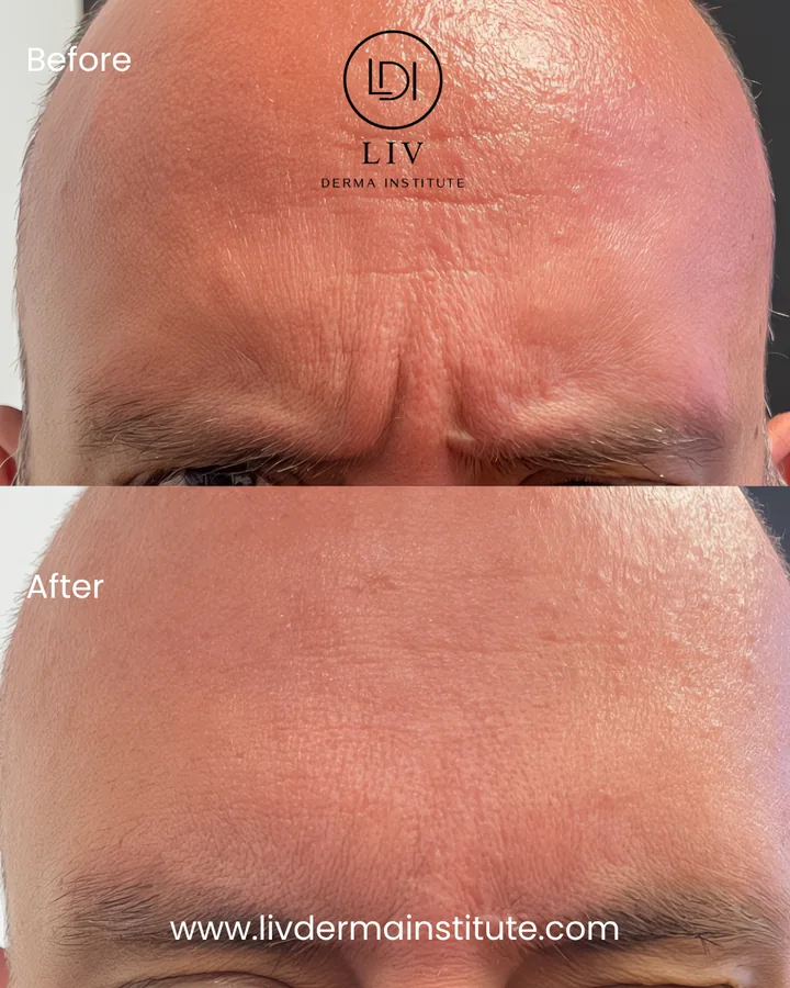 Voor en na: fronsrimpels – spierontspanners bij LIV Derma Institute