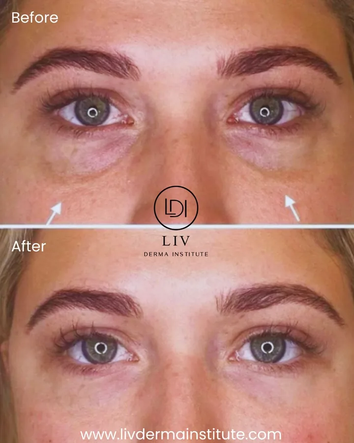 Voor en na: traangoot – filler bij LIV Derma Institute