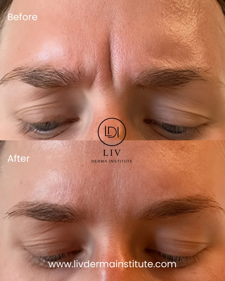 Voor en na: traangoot – filler bij LIV Derma Institute