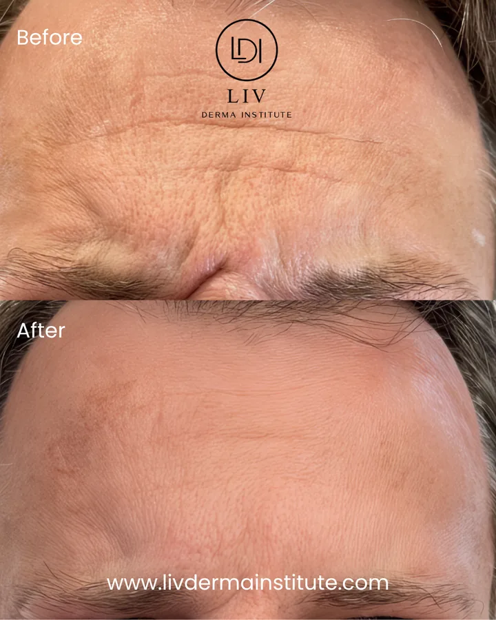Voor en na: voorhoofdrimpels – spierontspanners bij LIV Derma Institute