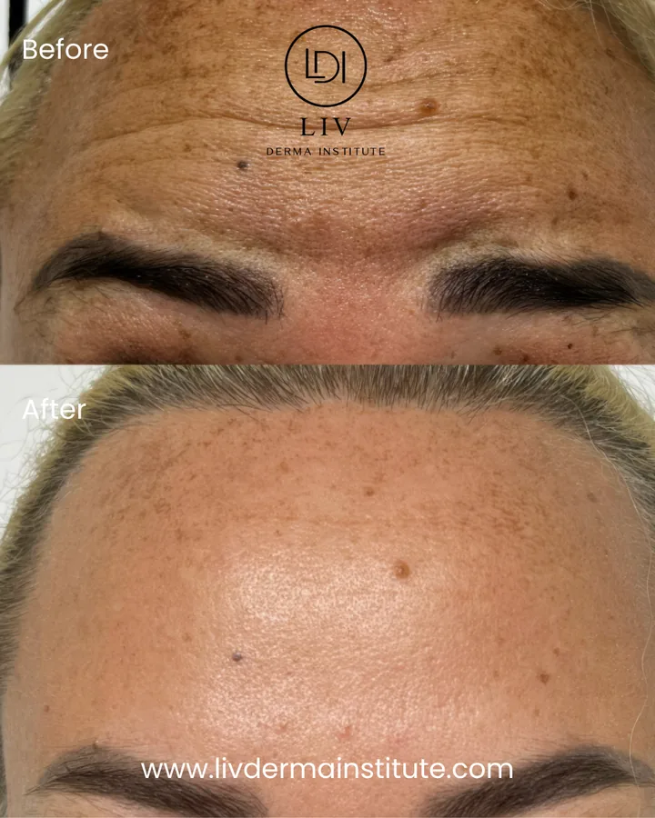 Voor en na: voorhoofdrimpels – spierontspanners bij LIV Derma Institute