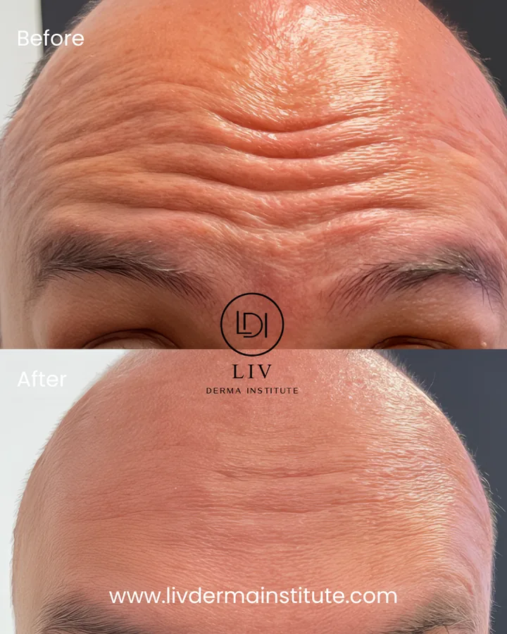 Voor en na: voorhoofdrimpels – spierontspanners bij LIV Derma Institute