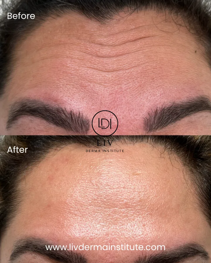 Voor en na: voorhoofdrimpels – spierontspanners bij LIV Derma Institute