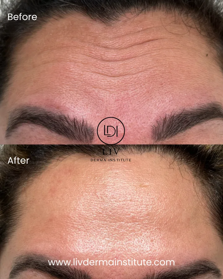 Voor en na: voorhoofdrimpels – spierontspanners bij LIV Derma Institute