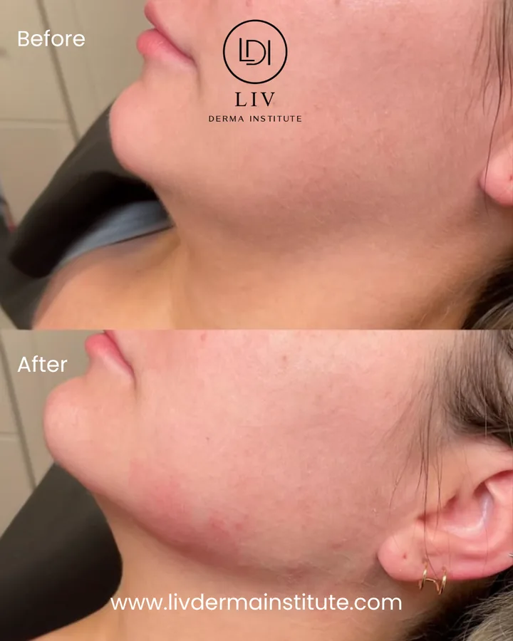 Voor en na: kaaklijn – filler bij LIV Derma Institute