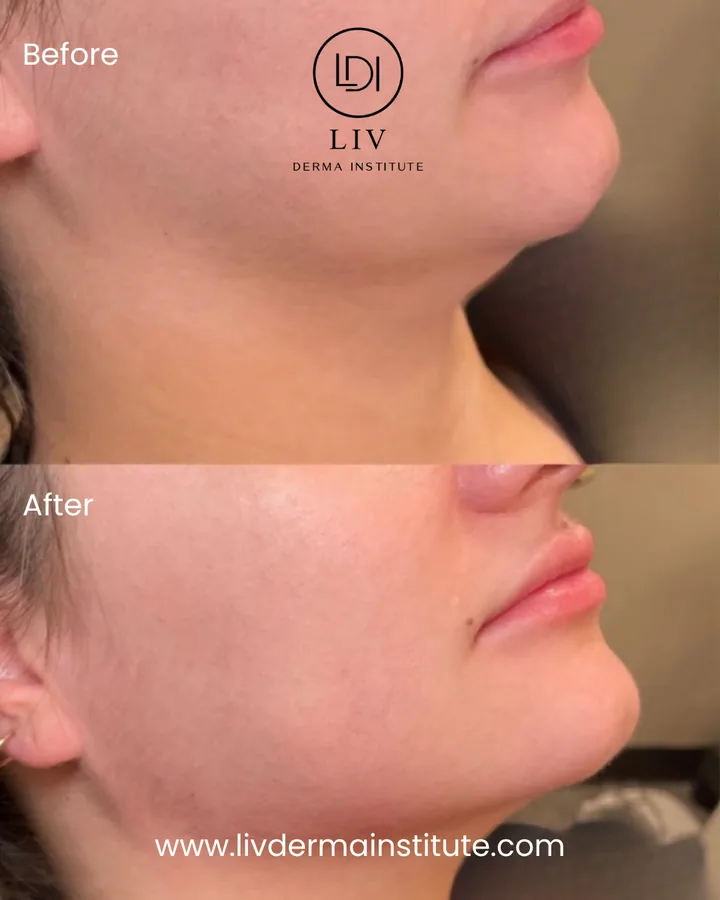 Voor en na: kaaklijn – filler bij LIV Derma Institute