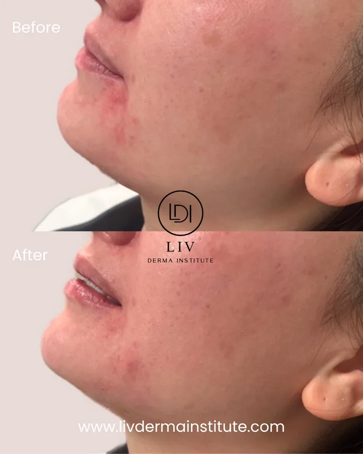 Voor en na: kaaklijn – filler bij LIV Derma Institute