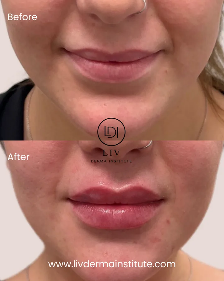 Voor en na: lippen – lipfiller bij LIV Derma Institute