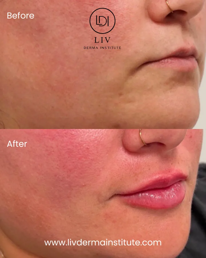Voor en na: lippen – lipfiller bij LIV Derma Institute