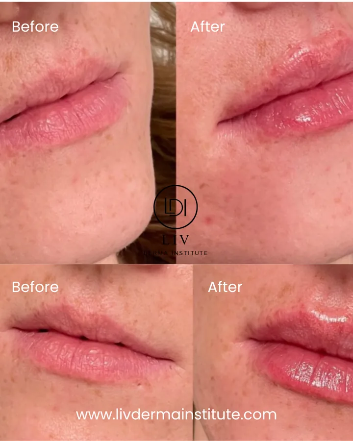 Voor en na: lippen – lipfiller bij LIV Derma Institute