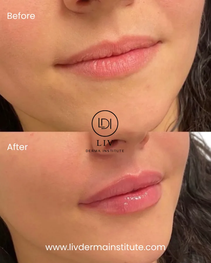 Voor en na: lippen – lipfiller bij LIV Derma Institute
