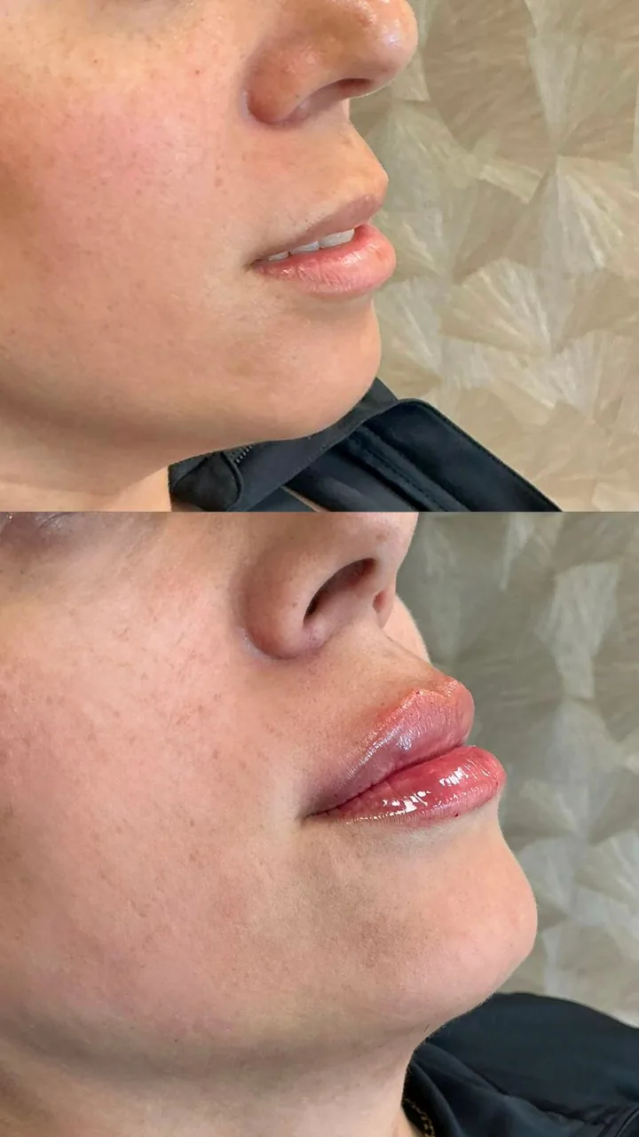 Voor en na: lippen – lipfiller bij LIV Derma Institute
