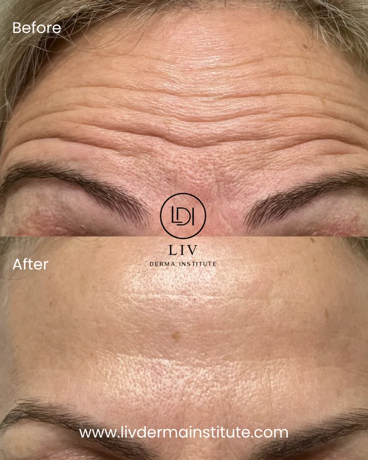 Voor en na: voorhoofdrimpels – spierontspanners bij LIV Derma Institute