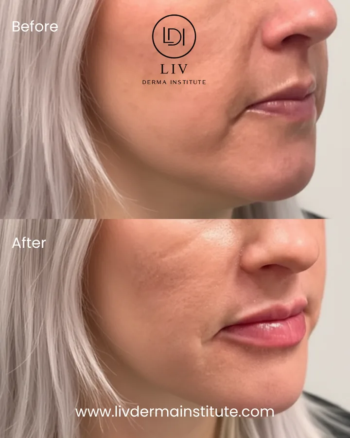 Voor en na: lippen – lipfiller bij LIV Derma Institute