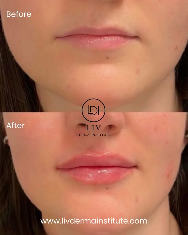 Voor en na: lippen – lipfiller bij LIV Derma Institute
