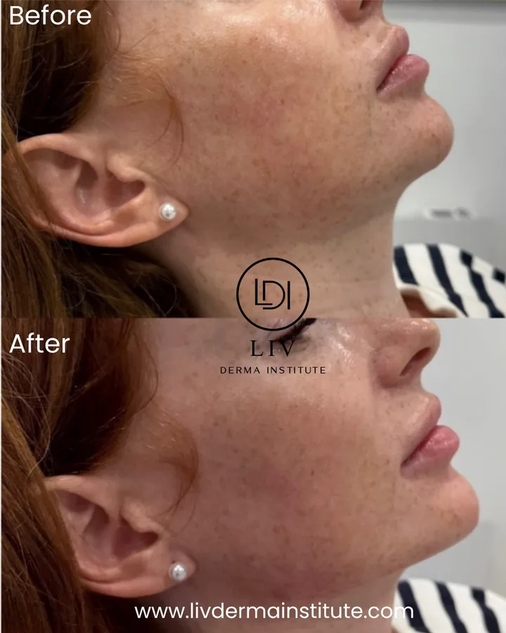 Voor en na: kaaklijn – filler bij LIV Derma Institute