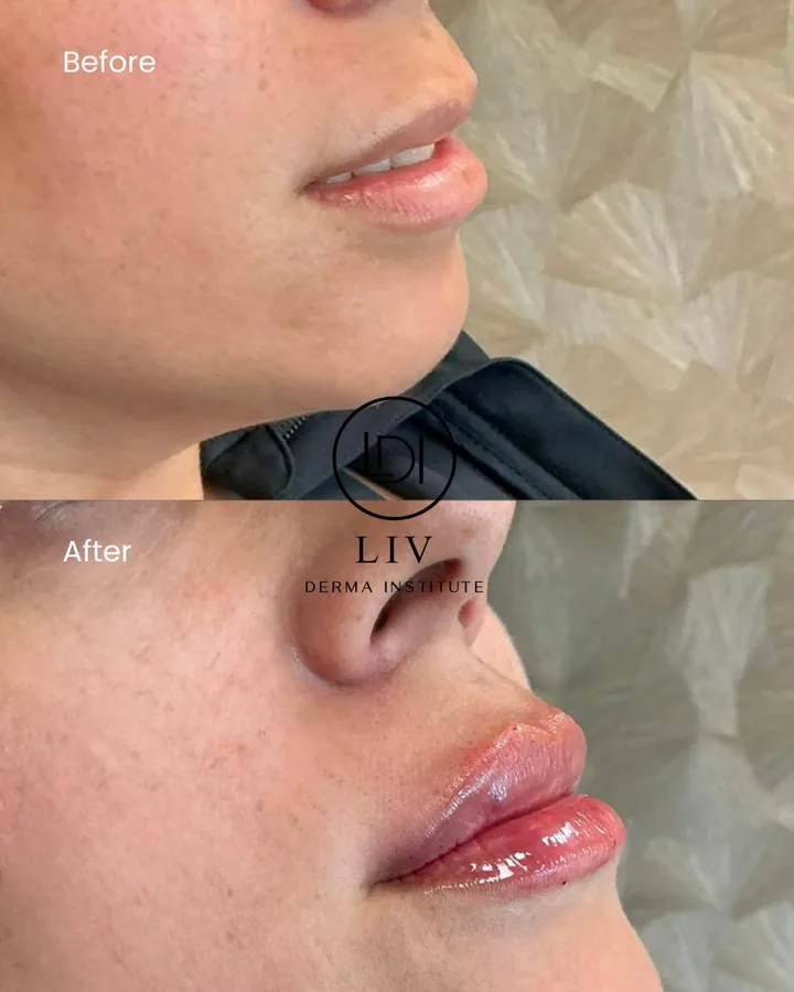 Voor en na: lippen – lipfiller bij LIV Derma Institute